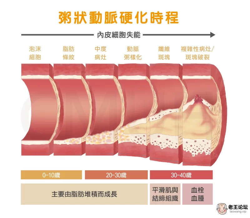 粥狀動脈硬化時程-01.jpg